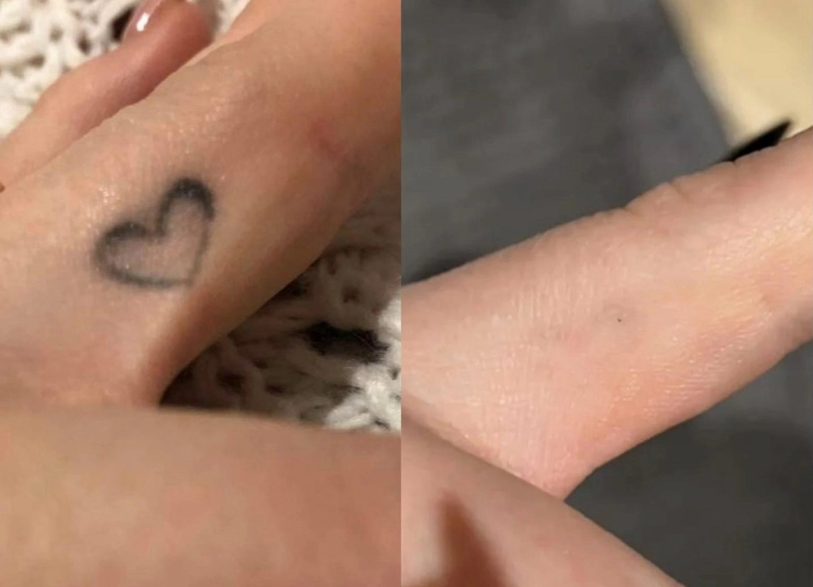 tattoo removed with Q-switch Laser