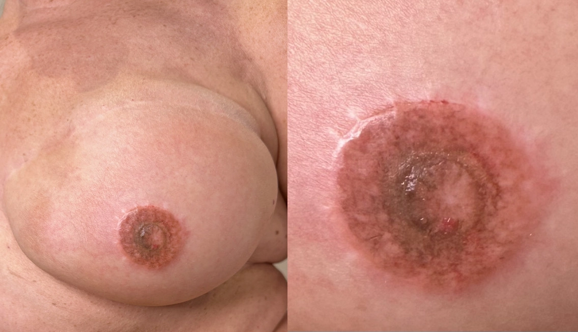 pigmentation done on the transplanted wart